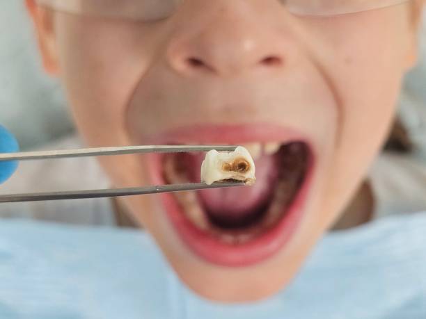 Best Urgent Care for Lost Fillings or Crowns in Chelan, WA
